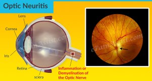 Optic-Neuritis1