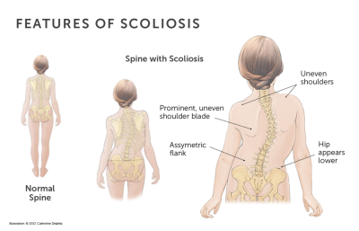Scoliosis-Treatment