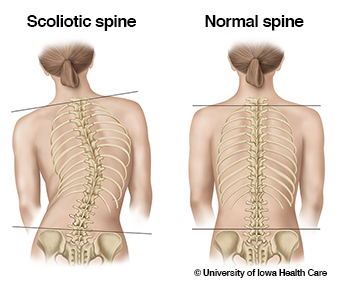 scoliotic-spine-normal-spine_0